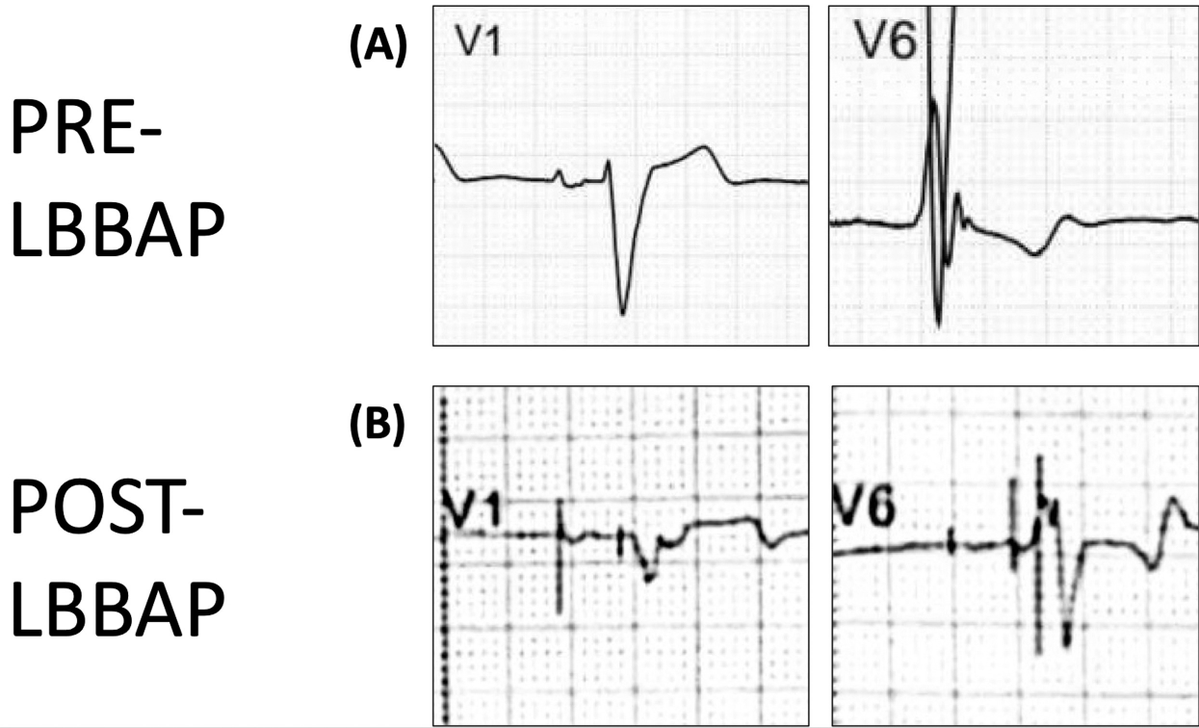Heart Rhythm Case Reports tweet media