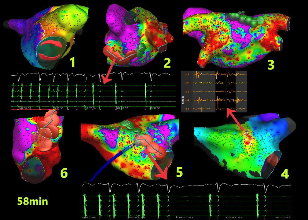 Michail Efremidis (@mefraimidis) on Twitter photo One more case of ATs ablated with AFFERA mapping system.
1. MFL 2. localized reentry at the anterior wall 3. CTI flutter
@ SteliosDragasis <a href="/ipetemil/">Panagiotis Mililis</a> <a href="/athsaplaouras/">Athanasios Saplaouras</a> <a href="/Kariki_O/">Ourania Kariki</a> <a href="/K_Letsas/">Konstantinos Letsas</a> <a href="/PetrosSkalidis/">Petros Skalidis</a> <a href="/Medtronic/">Medtronic</a> One more case of ATs ablated with AFFERA mapping system.
1. MFL 2. localized reentry at the anterior wall 3. CTI flutter
@ SteliosDragasis <a href="/ipetemil/">Panagiotis Mililis</a> <a href="/athsaplaouras/">Athanasios Saplaouras</a> <a href="/Kariki_O/">Ourania Kariki</a> <a href="/K_Letsas/">Konstantinos Letsas</a> <a href="/PetrosSkalidis/">Petros Skalidis</a> <a href="/Medtronic/">Medtronic</a>