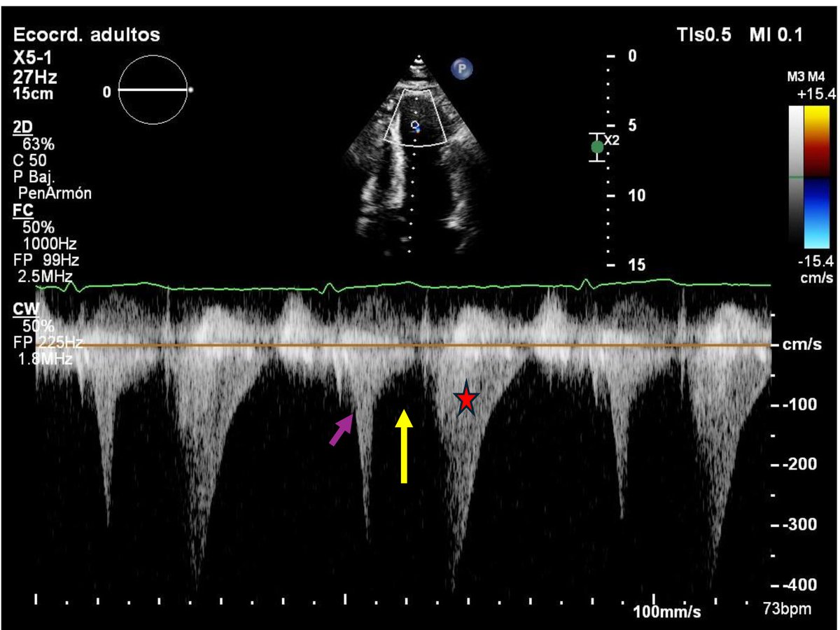 SISIAC (@sisiacoficial) on Twitter photo Sabes que sucede en este paciente con Cardiomiopatía Hipertrófica? Cortesía <a href="/JuanFeVas08/">Juan Felipe Vasquez R</a> Sabes que sucede en este paciente con Cardiomiopatía Hipertrófica? Cortesía <a href="/JuanFeVas08/">Juan Felipe Vasquez R</a>