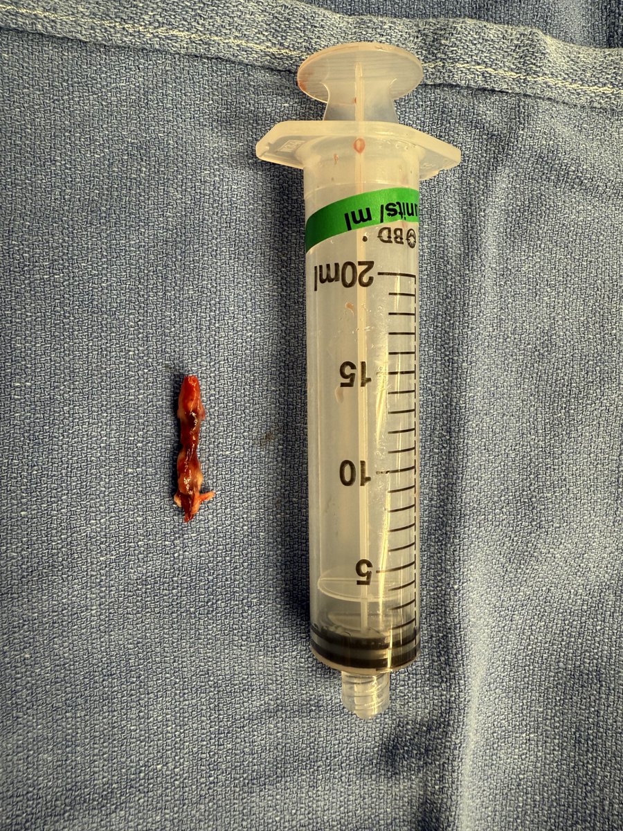 Mike_Roark's tweet photo. A focal chronic clot was successfully aspirated using the innovative CLEANER Vac device. The device's targeted aspiration capability and suction control proved invaluable in this case. With a single pulse of the trigger, the thrombus was effectively removed. https://t.co/TKQmAX6My9