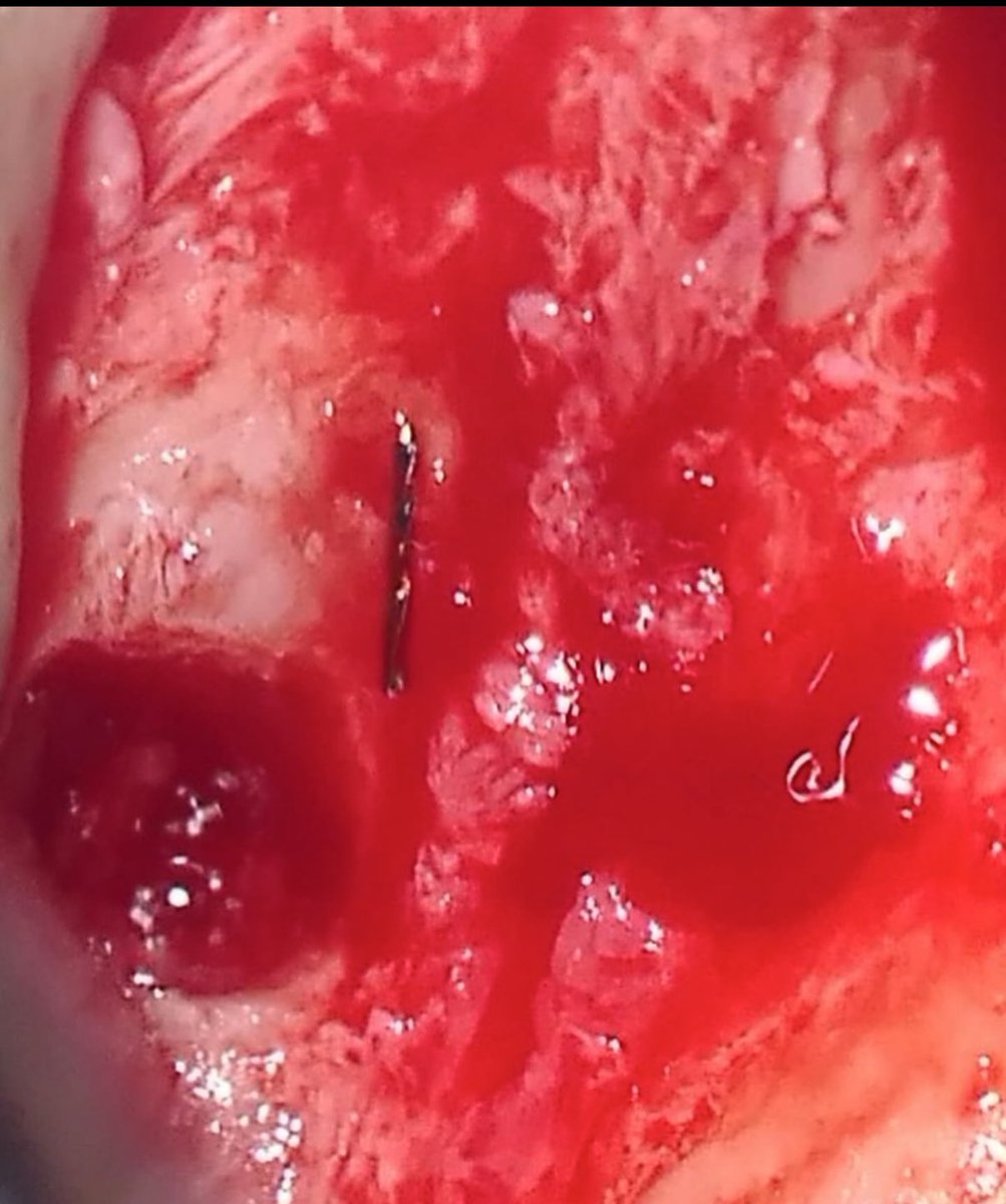 بسم الله نبدأ 
First endo surgery (Apicoectomy) for tooth #12
Dx: previously treated with symptomatic apical periodontitis + broken file beyond the apex