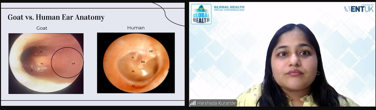 ENT UK (@ent_uk) on Twitter photo The <a href="/ENTUKGlobal/">ENT UK Global Health</a> Health 2024 Virtual Conference is in full swing! After a fantastic morning of talks, we are now onto some inspiring free paper sessions, including Harshada Kurande's talk on creating An 'Ear-Resistible' Programme for Training In Endoscopic Ear Surgery. The <a href="/ENTUKGlobal/">ENT UK Global Health</a> Health 2024 Virtual Conference is in full swing! After a fantastic morning of talks, we are now onto some inspiring free paper sessions, including Harshada Kurande's talk on creating An 'Ear-Resistible' Programme for Training In Endoscopic Ear Surgery.