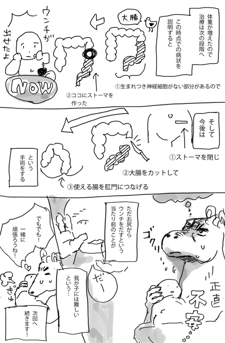 赤ちゃんのストーマ管理の話(3/3) 