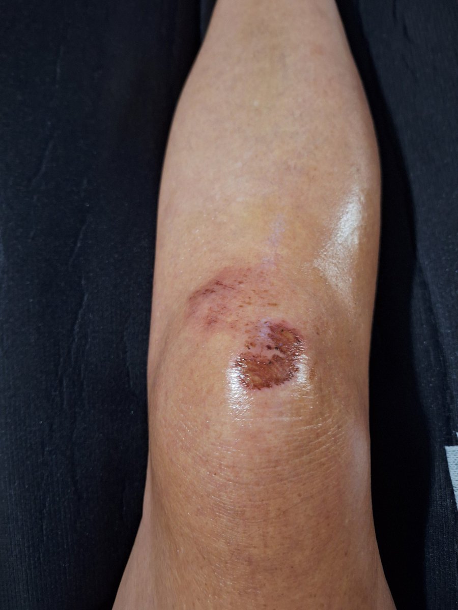 myowneyesnears's tweet photo. Day 4. A little bit swollen cuz I think I went too far yesterday. No #mulleinleaf tea before I went to sleep and I didn't sleep well at all.
#Comfrey
#KnitBone
#HerbalRemedies https://t.co/aAhkS3dE4x
