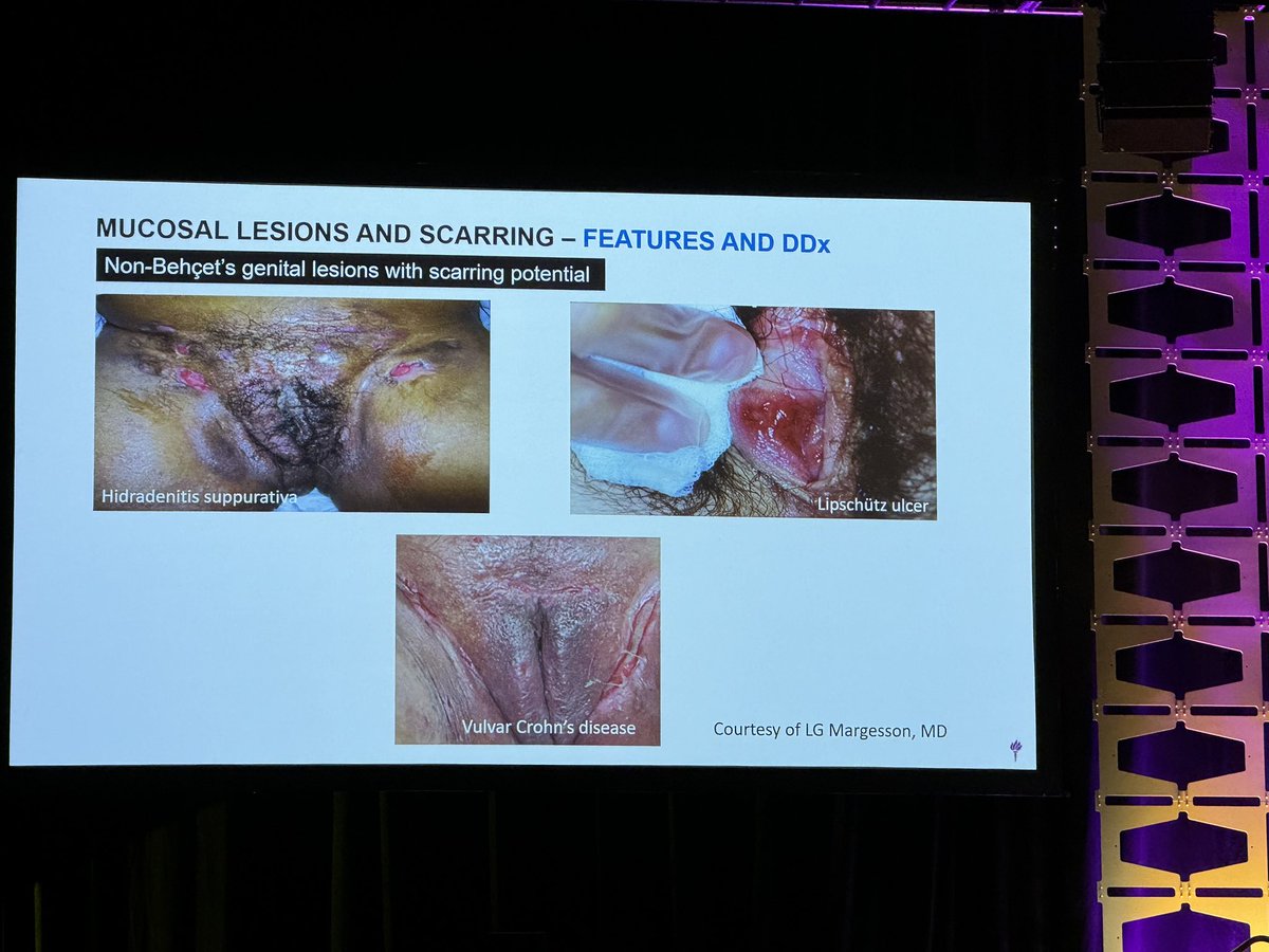 KDAO2011's tweet photo. Not all genital ulcers are due to #Bechet’s … consider other diseases #ACR24 #ACRReview https://t.co/kEgiHWFTfE