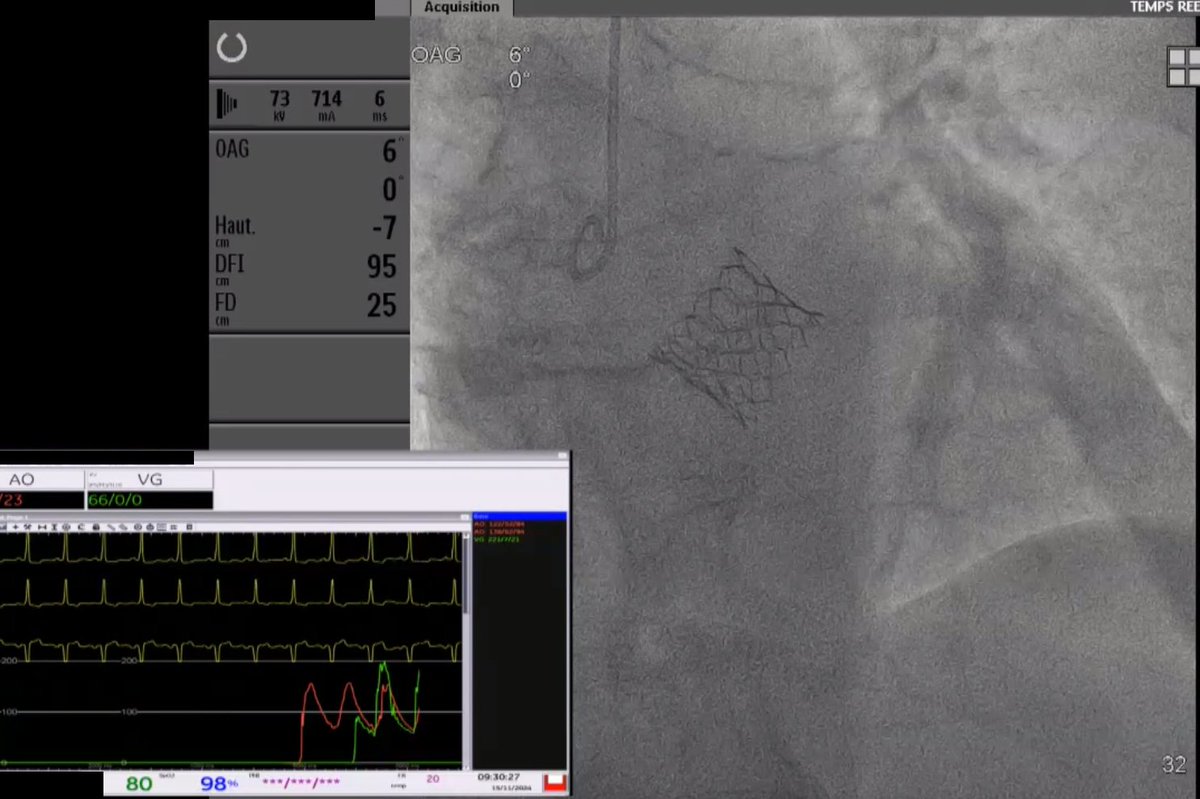 Service de Cardiologie - CHU de Rouen (@cardio_churouen) on Twitter photo 📣 Le Pr Eltchaninoff rend hommage au Pr Alain Cribier lors d'une conférence, avant de réaliser un cas de #TAVI en direct avec le Dr Tron au <a href="/CHURouen/">CHU de Rouen</a> pour le congrès #HyberadadValves2024. Un événement riche en partage d'expertise et d'innovation.
<a href="/heleltchaninoff/">Eltchaninoff</a> 📣 Le Pr Eltchaninoff rend hommage au Pr Alain Cribier lors d'une conférence, avant de réaliser un cas de #TAVI en direct avec le Dr Tron au <a href="/CHURouen/">CHU de Rouen</a> pour le congrès #HyberadadValves2024. Un événement riche en partage d'expertise et d'innovation.
<a href="/heleltchaninoff/">Eltchaninoff</a>