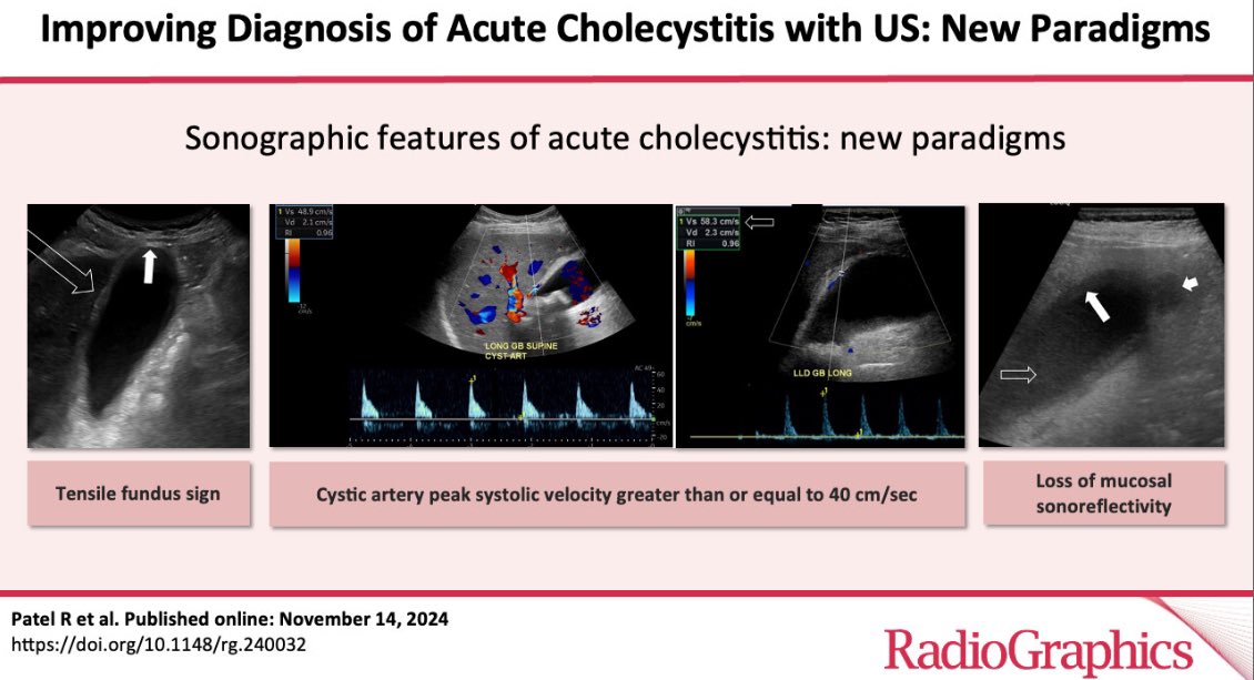 Richa Patel (@richapatelmd) on Twitter photo Accurate diagnosis of acute cholecystitis is tricky. Luckily, new paradigm signs can make it easier. Excited to share our latest in <a href="/RadioGraphics/">RadioGraphics</a>! 📌
Read here! 📝
pubs.rsna.org/doi/10.1148/rg…
<a href="/ayakamaya/">Aya Kamaya, MD</a> <a href="/Luyaoshenmd/">Luyao Shen, MD</a> <a href="/JustinTseMDRad/">JustinTseMDRadiology</a> <a href="/StanfordBodyRad/">Stanford Body Imaging</a> Accurate diagnosis of acute cholecystitis is tricky. Luckily, new paradigm signs can make it easier. Excited to share our latest in <a href="/RadioGraphics/">RadioGraphics</a>! 📌
Read here! 📝
pubs.rsna.org/doi/10.1148/rg…
<a href="/ayakamaya/">Aya Kamaya, MD</a> <a href="/Luyaoshenmd/">Luyao Shen, MD</a> <a href="/JustinTseMDRad/">JustinTseMDRadiology</a> <a href="/StanfordBodyRad/">Stanford Body Imaging</a>