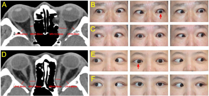 Ophthopedia Update: One-Stage Orbital Decompression Combined with Intraoperative Muscle Relaxation for TAO: A Randomized Controlled Trial dlvr.it/TGC141 #Ophthalmology #Ophthotwitter #Scicomm