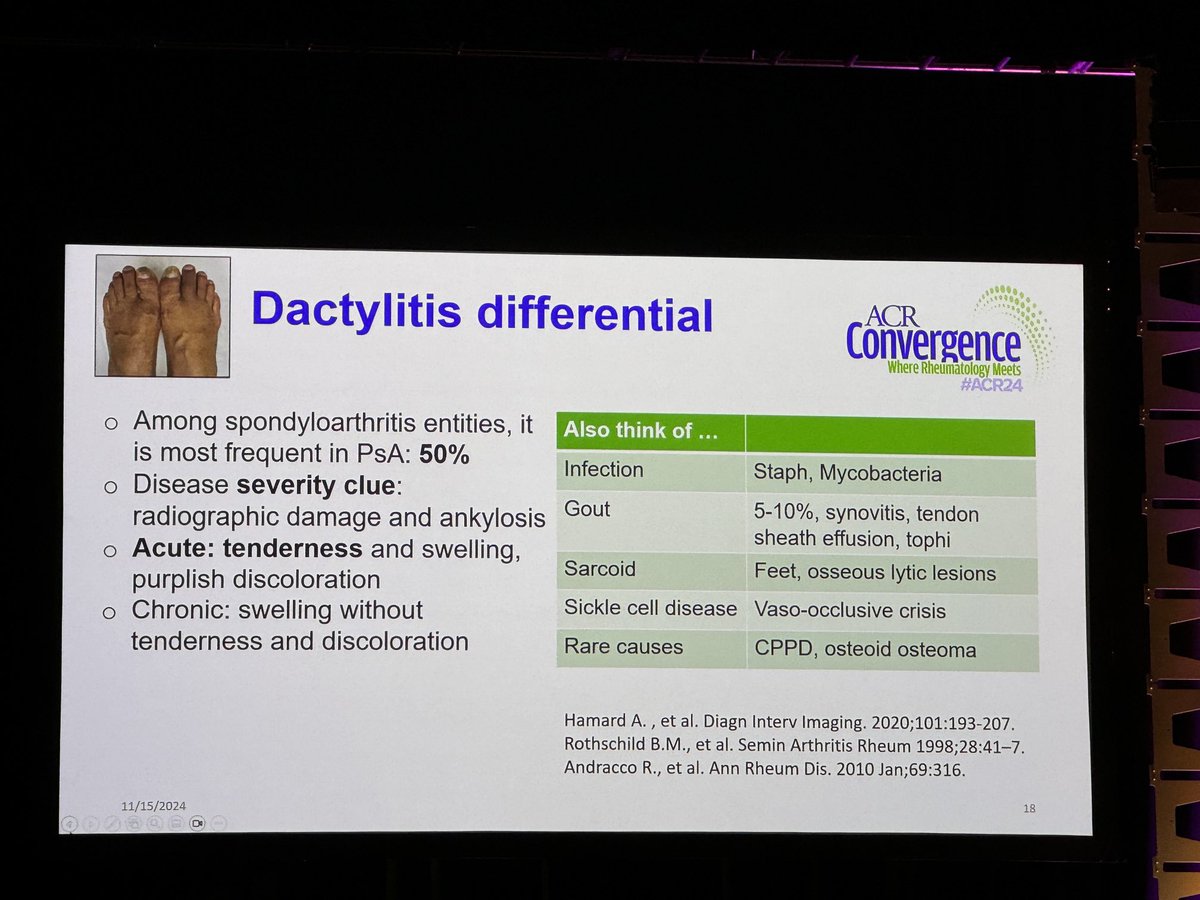KDAO2011's tweet photo. DDx #dactylitis: sarcoidosis, sickle cell dz, CPPD, infx and gout. #ACR24 #ACRReview https://t.co/qu3dHCy2V6