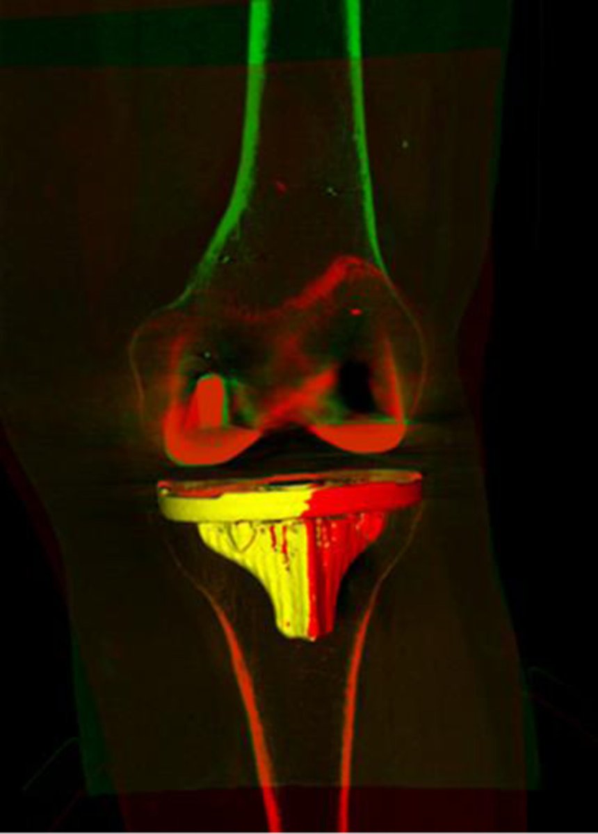 Excited to share that Rebecca's paper describing RSA inducible displacement measurements with weight-bearing CT (WBCT) is now online! WBCT is going to be a valuable tool in orthopaedics, and WBCT-RSA is a new and better way to diagnose loose implants.

doi.org/10.1002/jor.26…