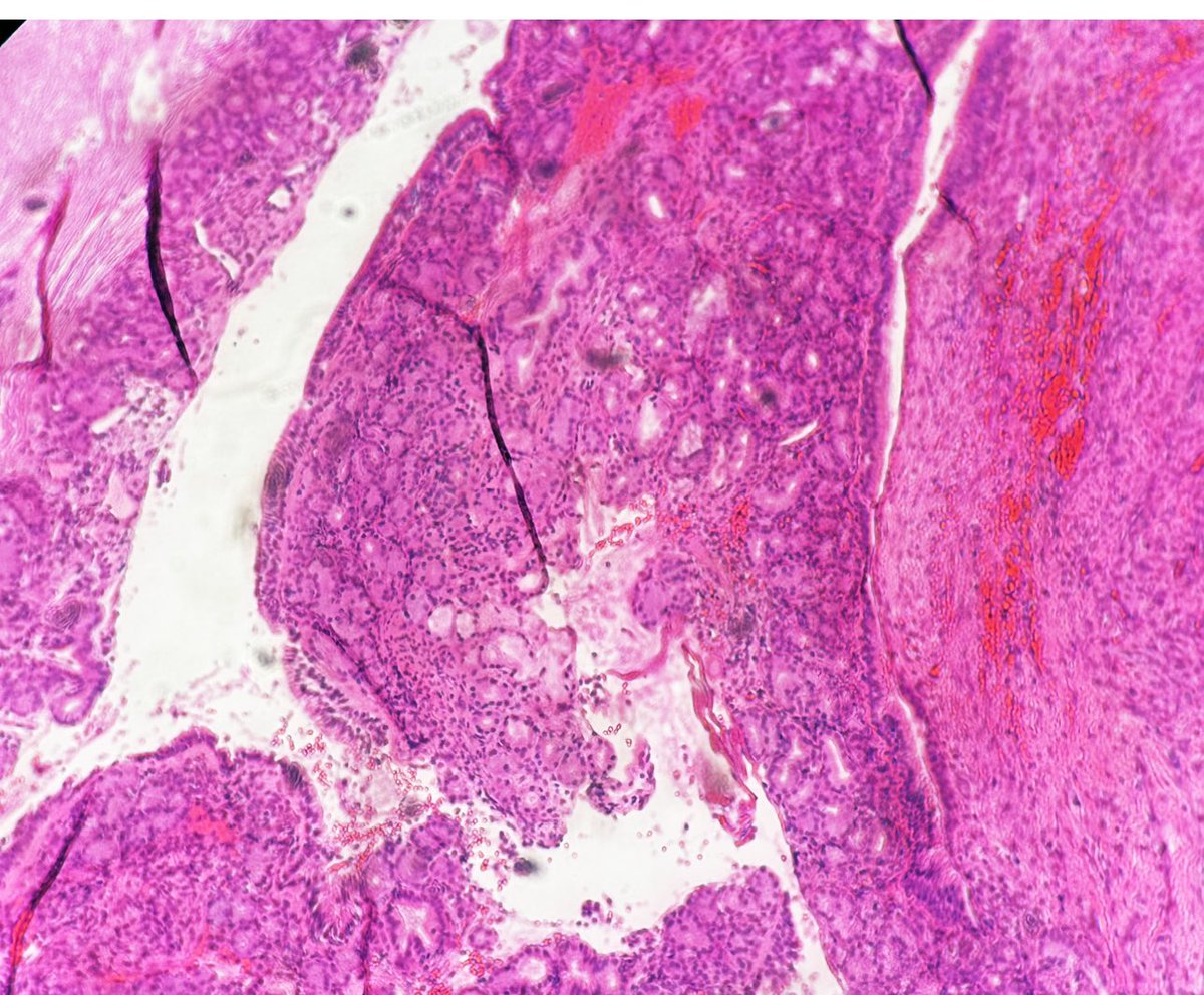 Hello 

Nasal mass 32 Female 
 Any thoughts please ?

<a href="/Hashimoto__0/">Hisham Alshuaibi</a> 
<a href="/DrGeeONE/">Olaleke Folaranmi</a> 
<a href="/ENT_Path/">Cleveland Clinic Head and Neck Pathology</a>
<a href="/DanGrahamMD/">Dan Graham</a> 
<a href="/PATHtweets/">PATH</a>