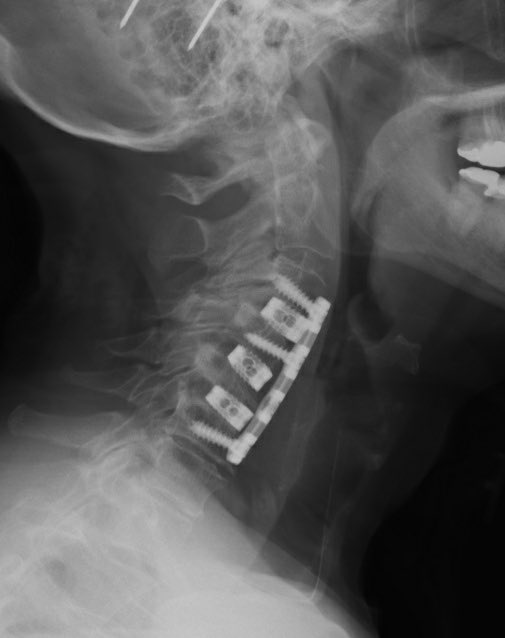 Ali A. Baaj MD tweet media