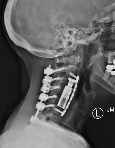 Ali A. Baaj MD tweet media