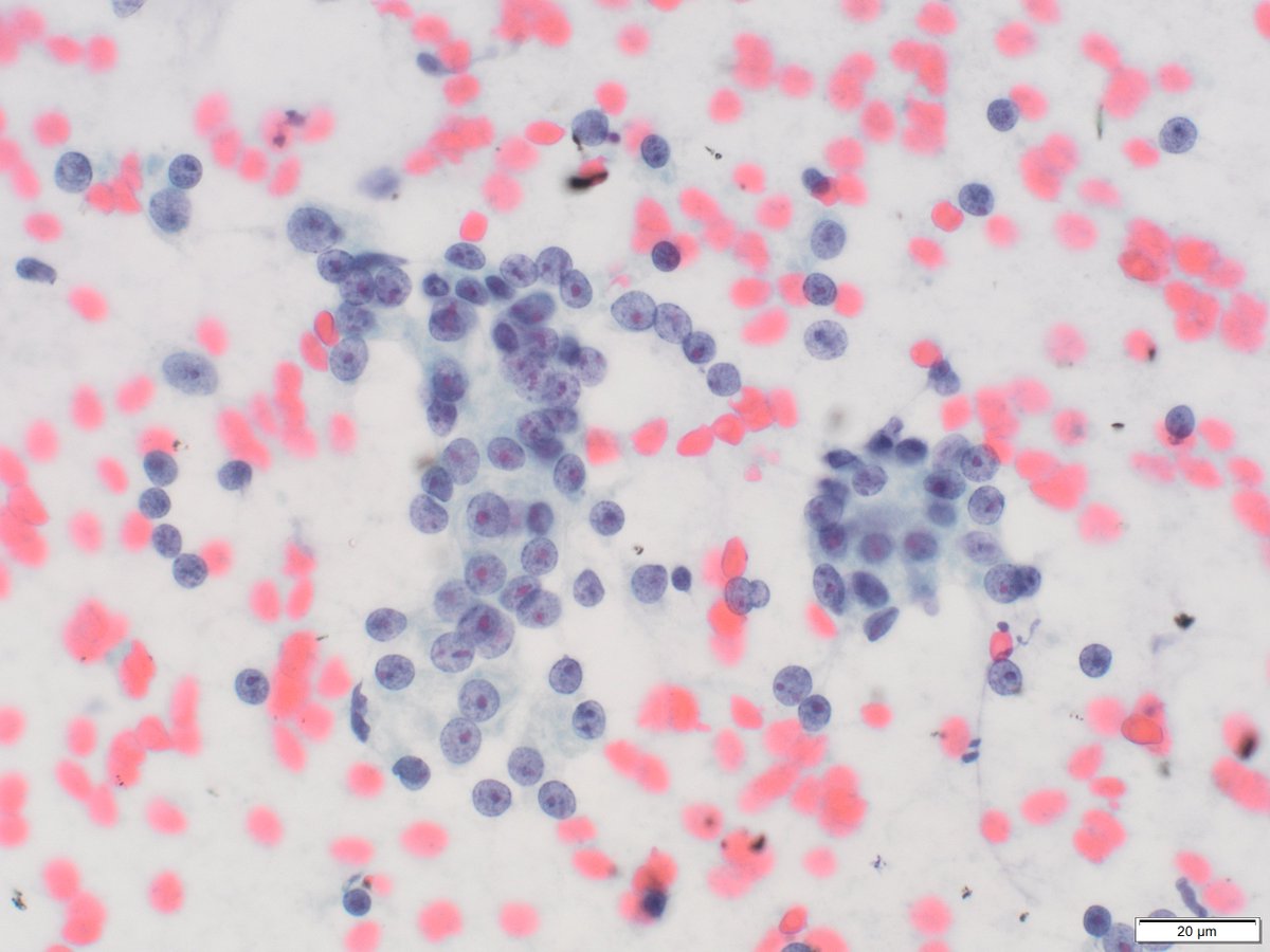 Pre-auricular node FNA for this #FNAFriday.
