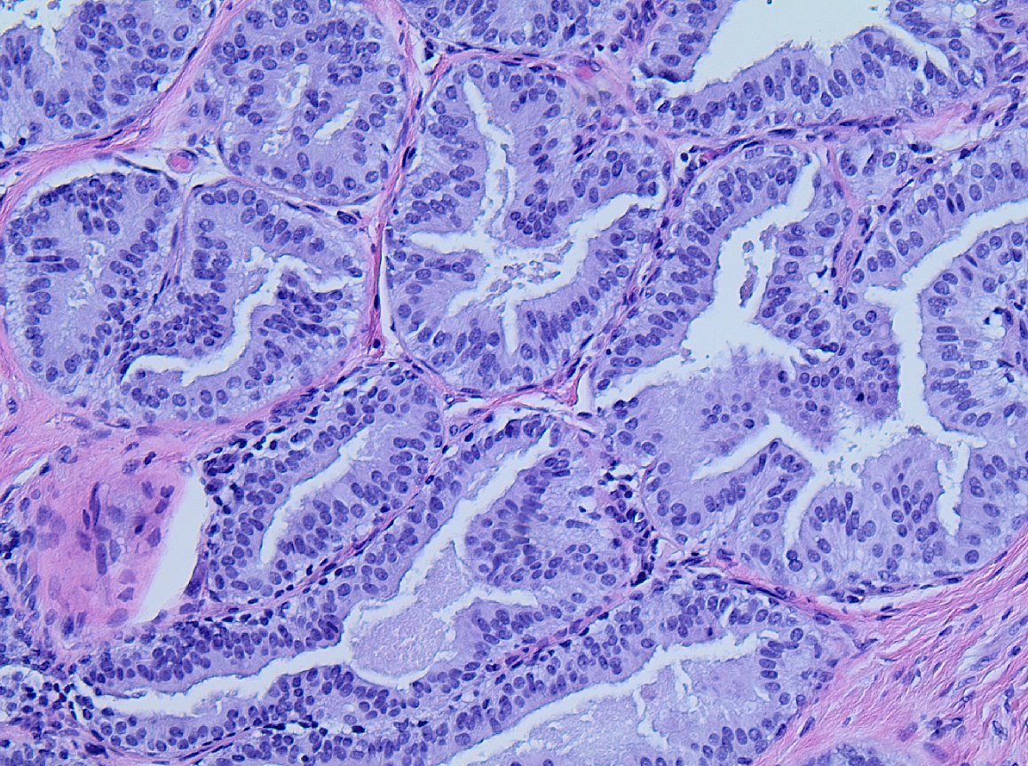 #breastpath Core biopsy done for calcifications. how should we sign out?