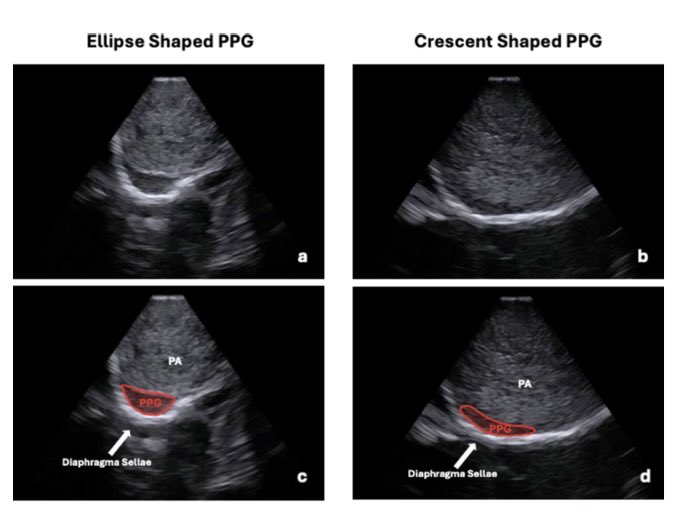 Guilherme Finger (@guilherme_fngr) on Twitter photo The <a href="/OSUWexMed/">The Ohio State University Wexner Medical Center</a> skullbase team have just published the first-ever paper on visualizing the posterior pituitary gland using endonasal ultrasound during transellar EEA. A real-time intraopweative imaging breakthrough! <a href="/ActaNeuro/">Acta Neurochirurgica</a> <a href="/PrevedelloDanny/">Danny Prevedello</a> <a href="/KyleWuMD/">Kyle Wu</a> <a href="/bk_Medical/">bk Medical</a> The <a href="/OSUWexMed/">The Ohio State University Wexner Medical Center</a> skullbase team have just published the first-ever paper on visualizing the posterior pituitary gland using endonasal ultrasound during transellar EEA. A real-time intraopweative imaging breakthrough! <a href="/ActaNeuro/">Acta Neurochirurgica</a> <a href="/PrevedelloDanny/">Danny Prevedello</a> <a href="/KyleWuMD/">Kyle Wu</a> <a href="/bk_Medical/">bk Medical</a>