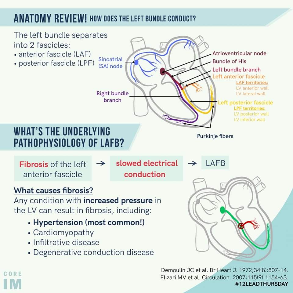 ZHeart11768530's tweet photo. 🔴Left anterior fascicular block (LAFB)
 
What is the formal criteria for LAFB?!
✅Left axis deviation w/o LVH
✅qR pattern in lead aVL
✅R-peak time in lead aVL of 45 ms or more
✅QRS duration less than 120 ms https://t.co/oFncdroRUI