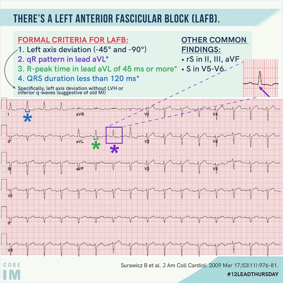 ZHeart11768530's tweet photo. 🔴Left anterior fascicular block (LAFB)
 
What is the formal criteria for LAFB?!
✅Left axis deviation w/o LVH
✅qR pattern in lead aVL
✅R-peak time in lead aVL of 45 ms or more
✅QRS duration less than 120 ms https://t.co/oFncdroRUI