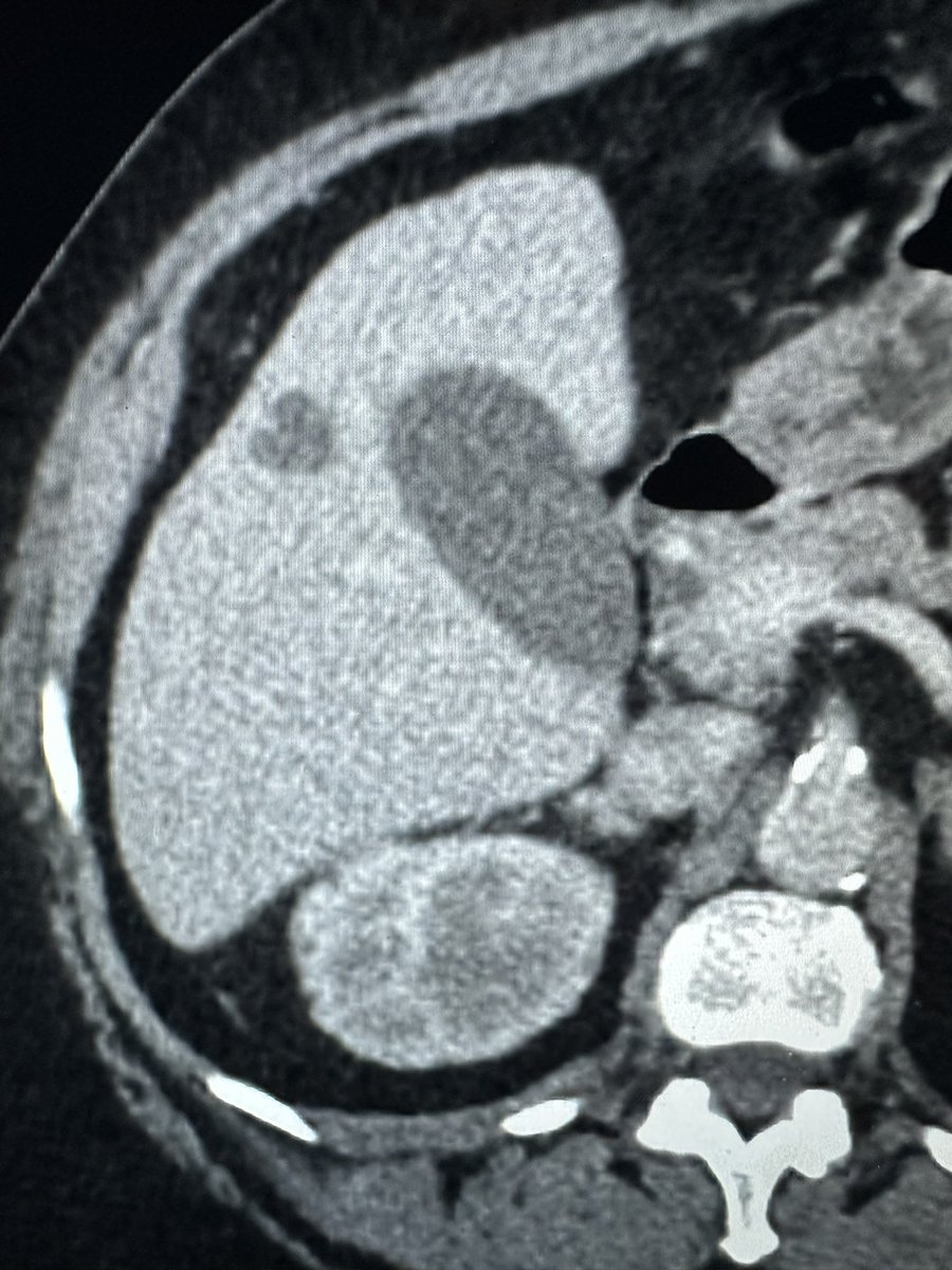 This liver sends his love!
