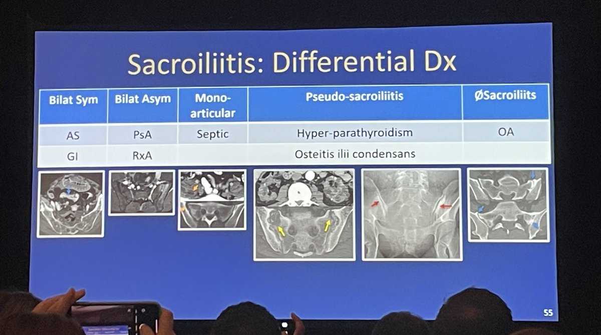 adil_fethi's tweet photo. Sacroiliitis DDx
- b/l symmetric: AS/GI
- b/l asymmetric: PsA, ReA
- u/l: septic
- pseudosacroiliitis: hyperPTH, osteitis condensans ilii
AS- spondy
🚨romanus lesions🚨 - shiny corners
🚨bamboo spine🚨 syndesmophytes 
🚨dagger sign🚨 trolley-track 🚨 https://t.co/EnlWzNSoMW