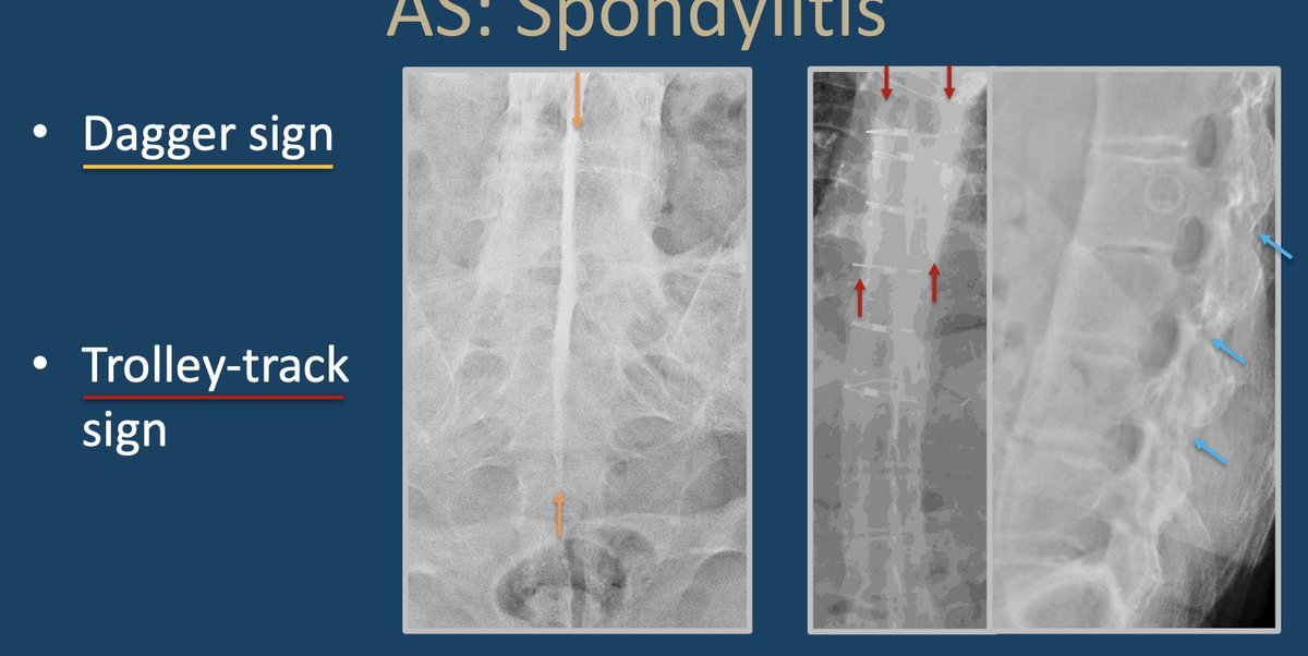 adil_fethi's tweet photo. Sacroiliitis DDx
- b/l symmetric: AS/GI
- b/l asymmetric: PsA, ReA
- u/l: septic
- pseudosacroiliitis: hyperPTH, osteitis condensans ilii
AS- spondy
🚨romanus lesions🚨 - shiny corners
🚨bamboo spine🚨 syndesmophytes 
🚨dagger sign🚨 trolley-track 🚨 https://t.co/EnlWzNSoMW
