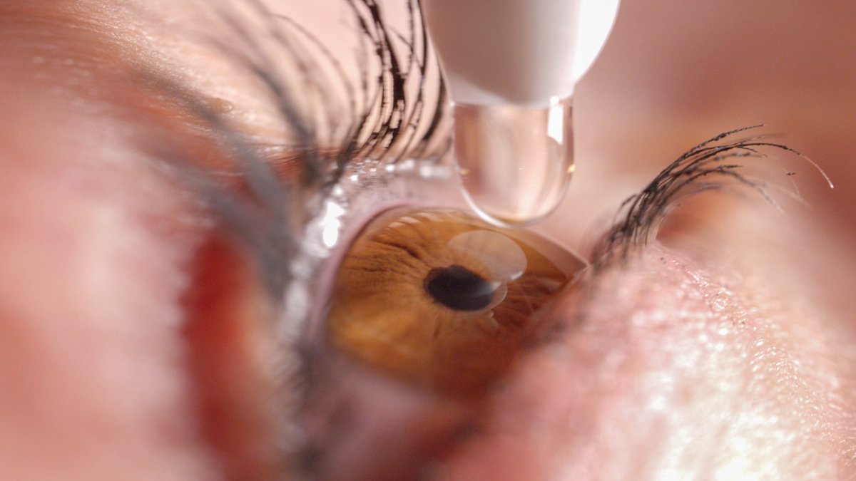 ophth_advisor's tweet photo. #AAO2024: CSF-1, a low-dose, preservative-free, #PilocarpineOphthalmicSolution, consistently reduces pupil size and improves #VisualOutcomes for patients with #Presbyopia, according to the results of the phase 3, NEAR-1 study and NEAR-2 study. @aao_ophth

Read more: https://t.co/SLbQ0zUsvm

#CSF1 #NEAR1 #NEAR2 #Ophthalmology