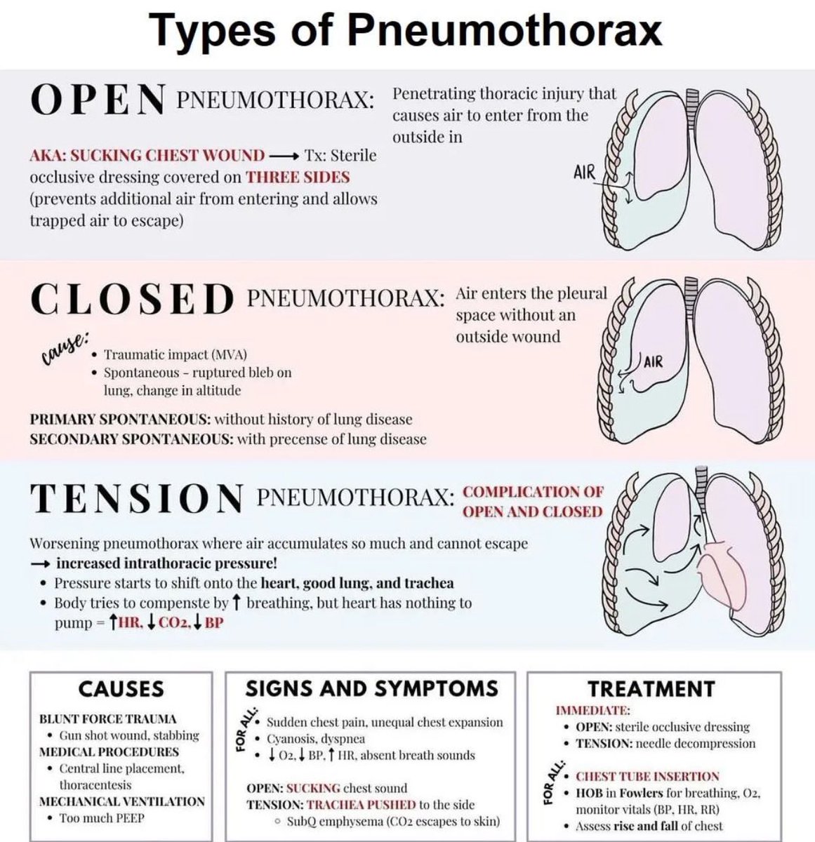 DrMedica_13's tweet photo. Types Of Pneumothorax 🫁
•••
#MedEd #MedX #PulmoMed https://t.co/nHOP7v7Z8d