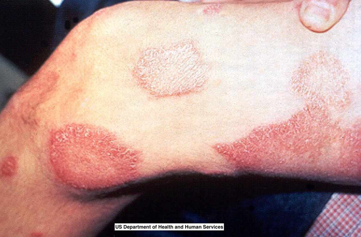 Path4People's tweet photo. I have been in history for thousands of years but surprisingly not highly contagious
I can be found in granulomas and like to go to the nerves
I can be sub classified into pauci or multi
Who am I +what is the stain⬇️?
#path4people #pathagonia #micro #pathx #medx #microx https://t.co/SWR4ZCF5iV