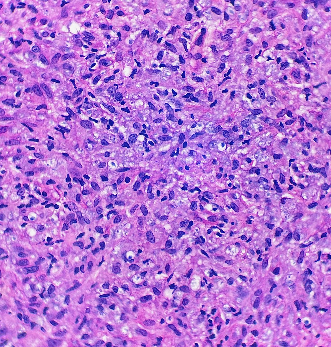 Path4People's tweet photo. I have been in history for thousands of years but surprisingly not highly contagious
I can be found in granulomas and like to go to the nerves
I can be sub classified into pauci or multi
Who am I +what is the stain⬇️?
#path4people #pathagonia #micro #pathx #medx #microx https://t.co/SWR4ZCF5iV