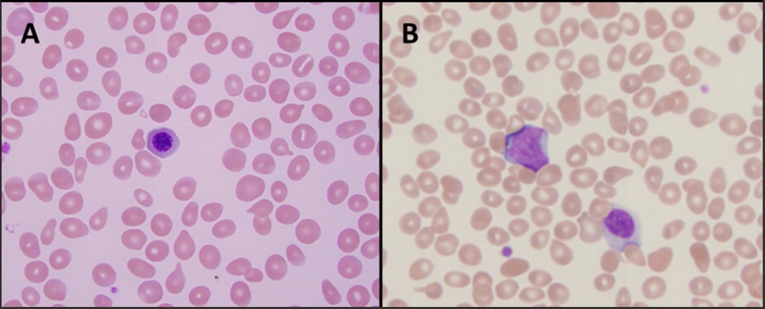 A man in his early 60s with a past medical history of essential thrombocythemia, diagnosed on bone marrow biopsy 20 years prior and treated with anagrelide and aspirin presented to his hematologist for routine blood work. 🧵