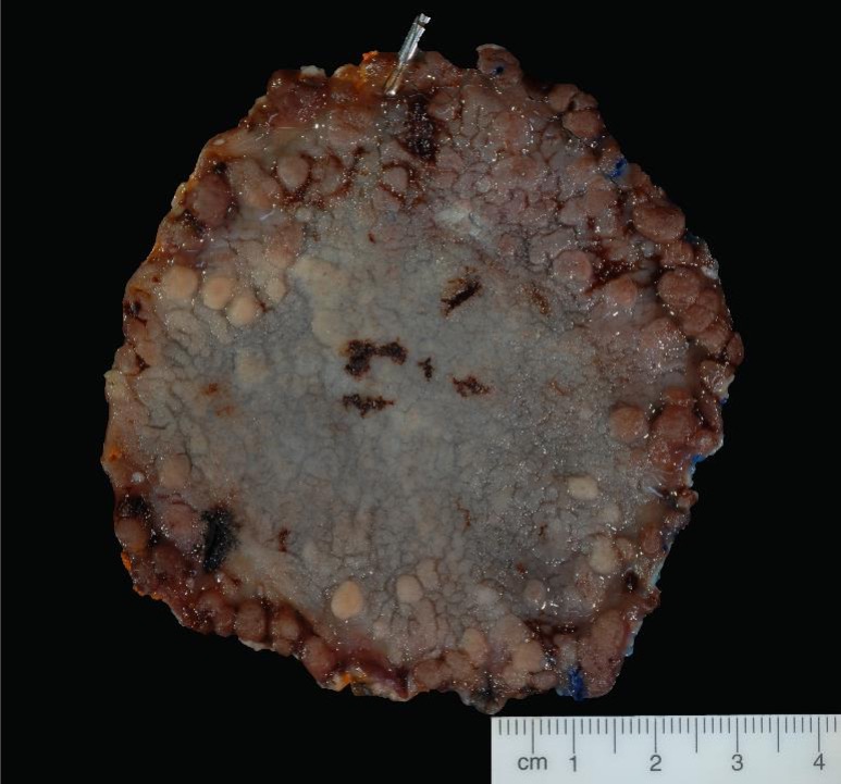 amitbhattMD's tweet image. Honored to give a combined talk with @burkegastrodoc @GIlymphomapath on endoscopic resection in FAP @CGAIGC and see Dr. Burke's team absolutely dominate GI Jeopardy!
Advanced endoscopy + polyposis 💪
@DavidLiskaMD @swatigp @AparajitaSingh0 @BilalMohammadMD @MRegueiroMD