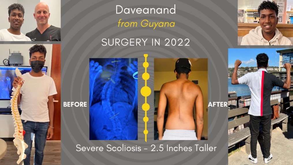 Update on Daveanand "Dave" Khemraj from Guyana, a scoliosis surgery patient who's living his dream! Fast forward 2.5 years, and Dave is now a successful electrician climbing to heights he never thought possible, feels confident in his body, and is back on the cricket field! 💪