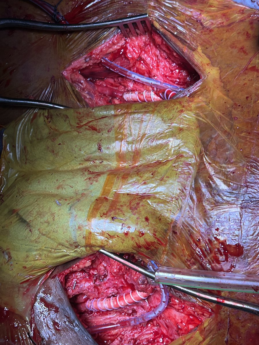 DrPShivanesan (@pshivanesandr) on Twitter photo 56/F with RHD severe MS with Aorto iliac occlusion ( thrombosed previous AF Bypass graft). Underwent MVR with Ventral Aortic repair- avoids redo laparotomy. Tunneled into sub rectus plane. #aortaed <a href="/PrajnaKota/">Prajna Kota MS, MCh</a> <a href="/World_fvs/">WFVS</a> <a href="/Vascular_India/">Vascular Society of India</a> 56/F with RHD severe MS with Aorto iliac occlusion ( thrombosed previous AF Bypass graft). Underwent MVR with Ventral Aortic repair- avoids redo laparotomy. Tunneled into sub rectus plane. #aortaed <a href="/PrajnaKota/">Prajna Kota MS, MCh</a> <a href="/World_fvs/">WFVS</a> <a href="/Vascular_India/">Vascular Society of India</a>