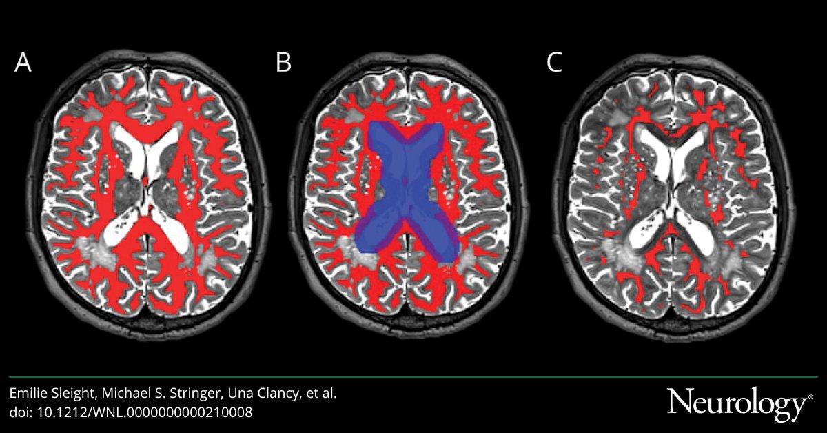 Neurology Journal (@greenjournal) on Twitter photo Association of Cerebrovascular Reactivity With 1-Year Imaging and Clinical Outcomes in Small Vessel Disease: An Observational Cohort Study bit.ly/3Z4zWbP Association of Cerebrovascular Reactivity With 1-Year Imaging and Clinical Outcomes in Small Vessel Disease: An Observational Cohort Study bit.ly/3Z4zWbP