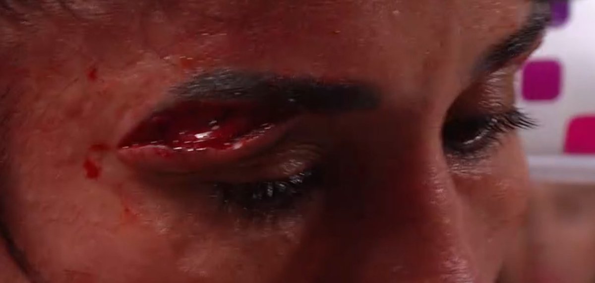 danabthomas's tweet photo. Serano's eyebrow has an eyeball now. Nothing stopping her. @Katietaylor is a beast too! Best female fight I've ever seen. #paultyson #netflixboxing https://t.co/2kesXyxYzj