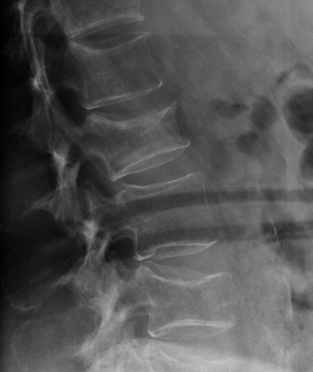 Pain in lower back. What injuries can you see and what is the underlying medical condition?