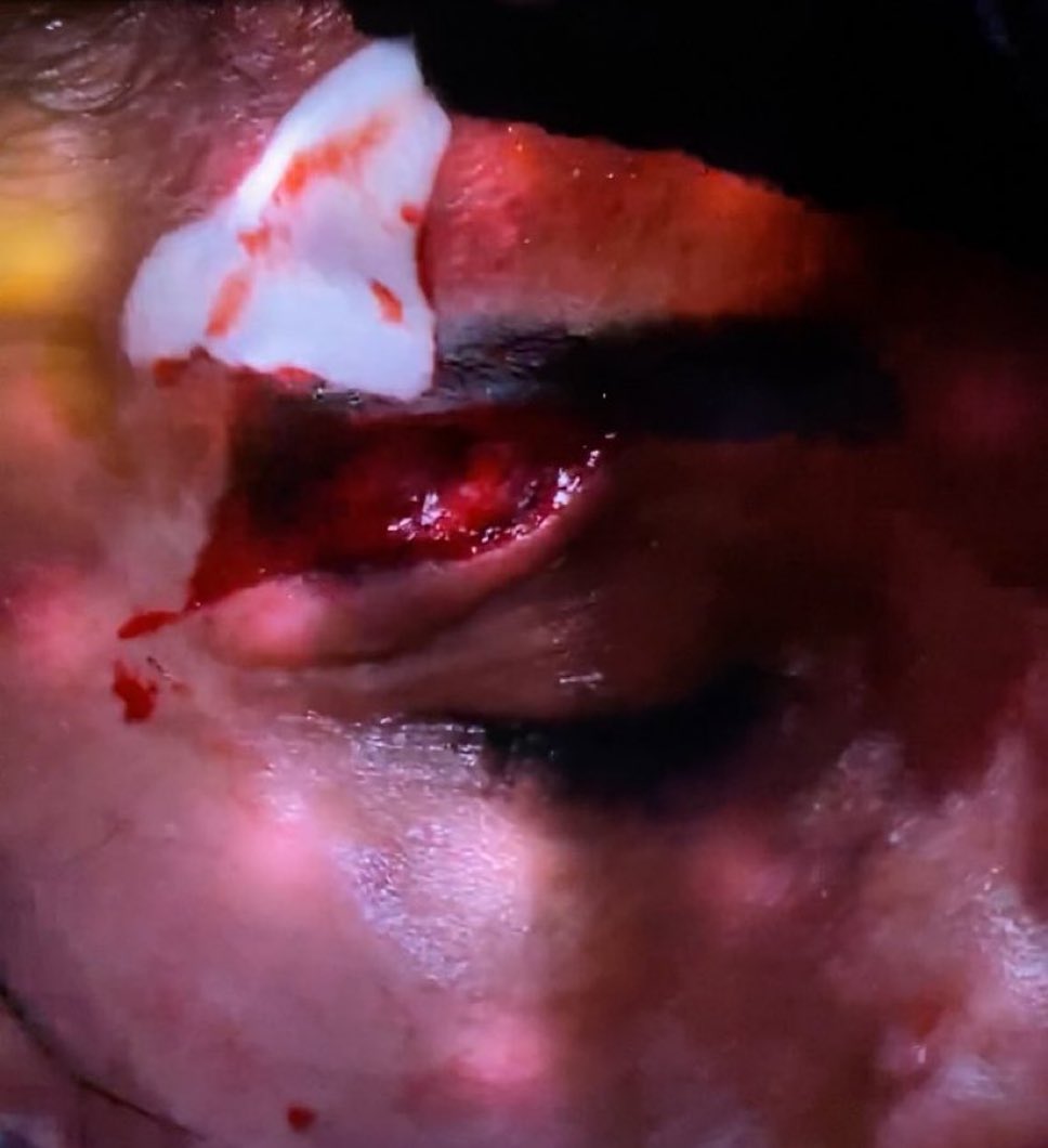 EsTendenciaEnX's tweet photo. “Amanda Serrano”:
Porque así quedó su ceja tras los cabezazos de Taylor, pegó 100 piñas más, y perdió https://t.co/N3RVMsOoGf