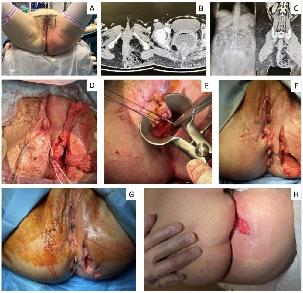 Ugo Grossi (@drugogrossi) on Twitter photo ⚔️Challenges in the diagnosis and management of #Fournier’s gangrene in #UlcerativeColitis #IBD
📰visit👉rdcu.be/dZZRx <a href="/colo_research/">#ColorectalResearch</a> <a href="/TechColoproctol/">Techniques in Coloproctology Journal</a> ⚔️Challenges in the diagnosis and management of #Fournier’s gangrene in #UlcerativeColitis #IBD
📰visit👉rdcu.be/dZZRx <a href="/colo_research/">#ColorectalResearch</a> <a href="/TechColoproctol/">Techniques in Coloproctology Journal</a>