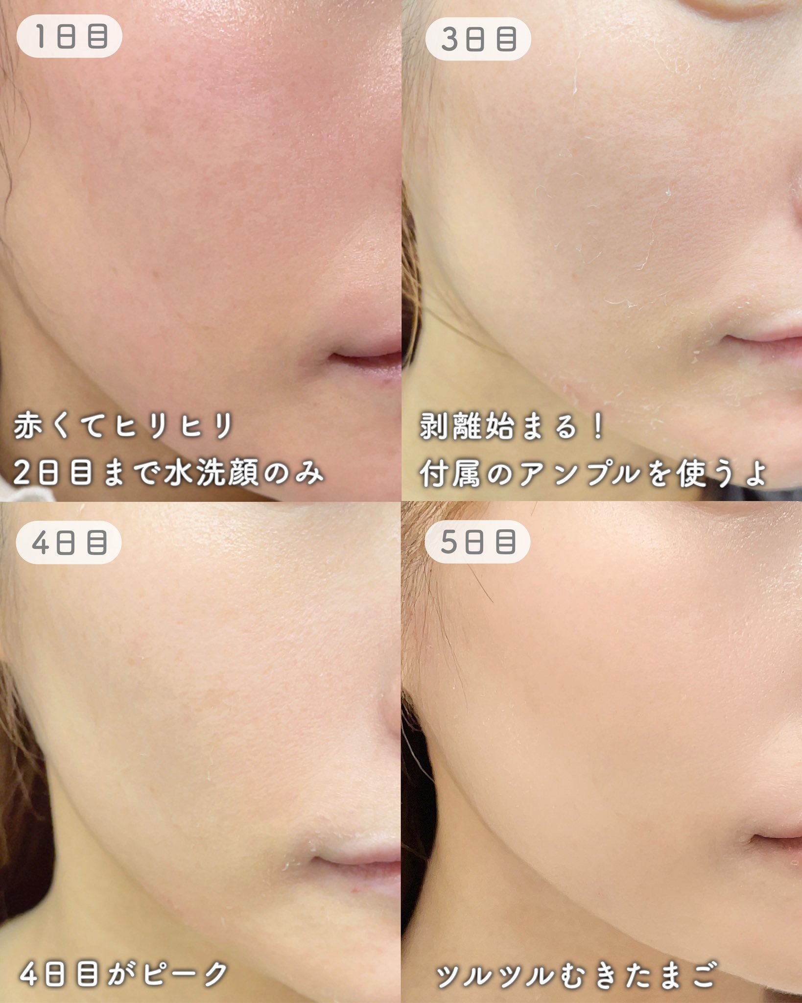 限定セット《剥離あり》皮むけありハーブピーリング4〜8回分国産農薬不