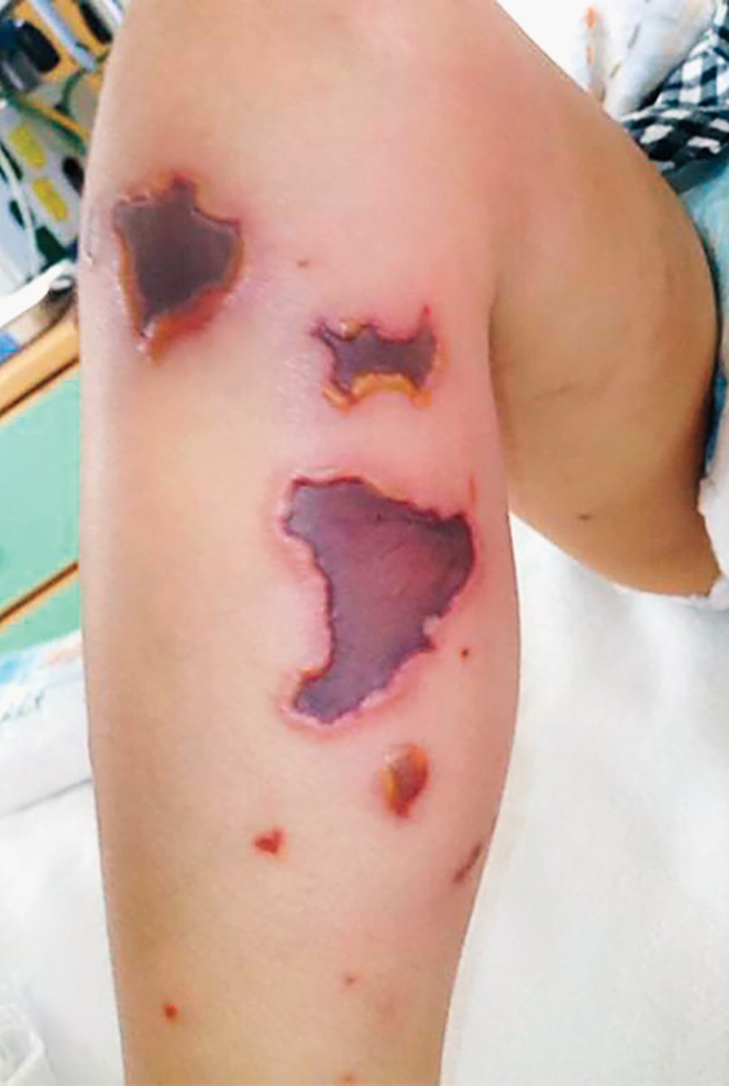 ManualOMedicine's tweet photo. A 3 y/o boy presented with fever, vomiting, and these skin lesions. He was found to have bacteremia with Neisseria meningitidis.
- What is the diagnosis ?

#medtwitter #foamed #usmle https://t.co/V8wiQgUF1X