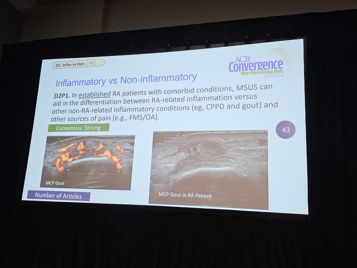 USSONAR (@ussonar_rh) on Twitter photo MSK #ultrasound can aid in differentiating between RA-related inflammation v. Other non RA related inflammation #ACR24 <a href="/ACRheum/">American College of Rheumatology</a> #RhMSUS MSK #ultrasound can aid in differentiating between RA-related inflammation v. Other non RA related inflammation #ACR24 <a href="/ACRheum/">American College of Rheumatology</a> #RhMSUS