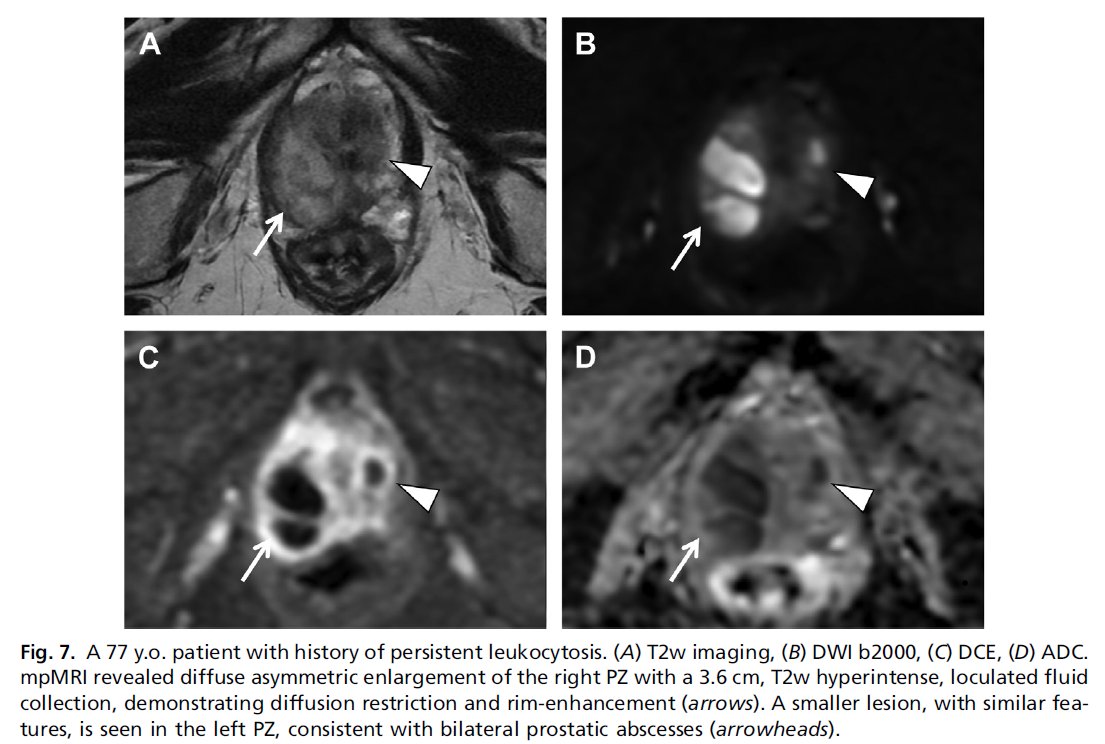 radiolobt's tweet image. 📣Urologic Imaging of the Prostate: Cancer and Mimics
🔷Excellent review article with amazing case samples by @mharisinghani  and his colleagues!
👍Congratulations to all Authors
🔖A must read document to learn more about #prostateMRI 
#TeamScience #Radiology…