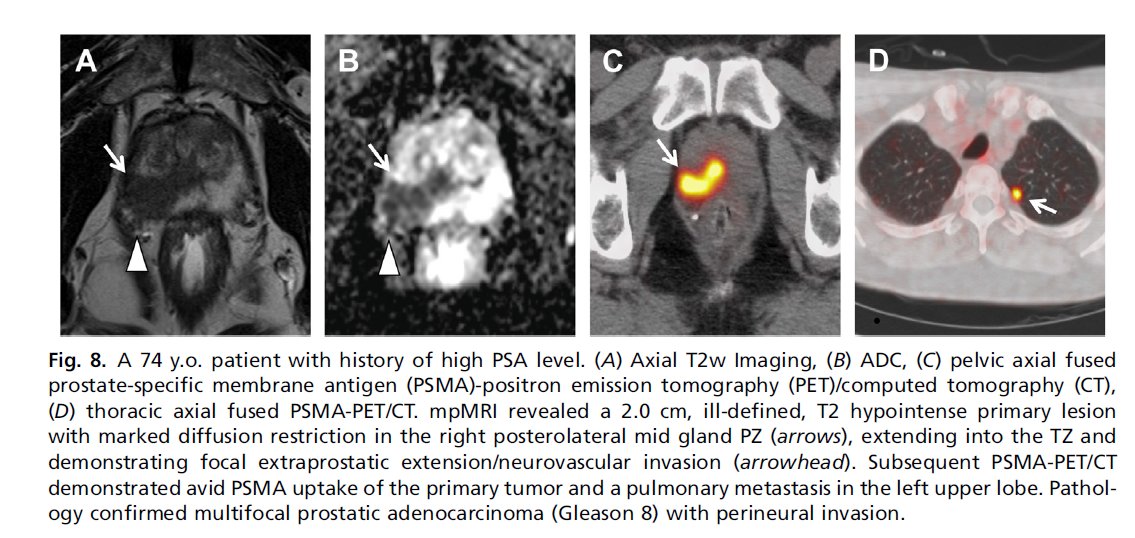 radiolobt's tweet image. 📣Urologic Imaging of the Prostate: Cancer and Mimics
🔷Excellent review article with amazing case samples by @mharisinghani  and his colleagues!
👍Congratulations to all Authors
🔖A must read document to learn more about #prostateMRI 
#TeamScience #Radiology…