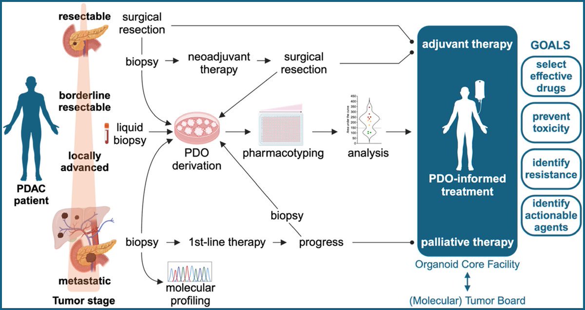 LumirKunovsky's tweet photo. 🔴 Organoid-based #precision #medicine in #pancreatic #cancer
💥 #Organoids ➡️ generated from #surgical #resections & tissue or liquid biopsies from treatment-naïve or pretreated #PDAC pts
💥 PDOs can be subjected to pharmacotyping & inform #treatment decisions https://t.co/hxef5uRIi2
