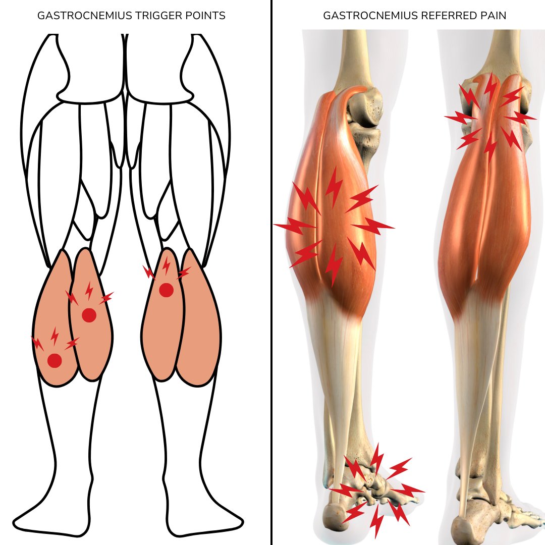 Nielasheredu's tweet image. Did you know that trigger points in your calf muscles, specifically the gastrocnemius, can cause pain that feels like it&apos;s coming from somewhere completely different? 
#TriggerPoints #Gastrocnemius #CalfPain #MyofascialRelease #ManualTherapy #MoveBetterLiveBetter