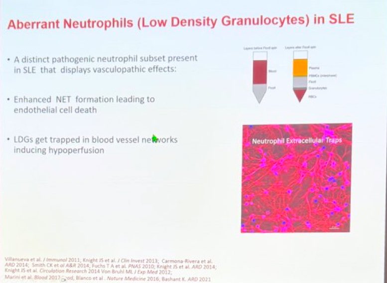 Rheumat_Aravind's tweet photo. Aberrant Neutrophils in SLE
#ACRReview #ACR2024 #ACR24 #ACR #Rheumatology https://t.co/Tqd3pP8Ya9