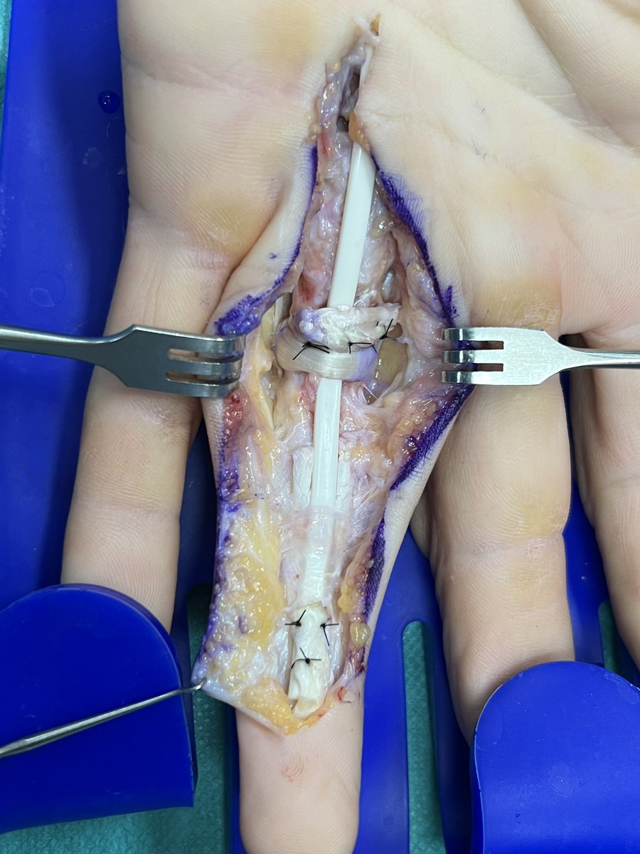 Pacomartinezmtn's tweet photo. Que hacer si fracasa la sutura de un tendón?Reparación secundaria :
1* tiempo: reparación de poleas, nervios y varilla de silastic.
Movilización precoz y con esto crearemos una neocanal para el tendón definitivo en segundo tiempo. https://t.co/PLicPOsLZ9