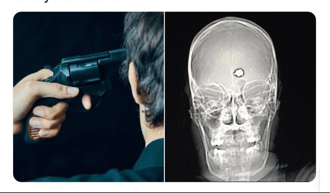 In the 1980s, a man with severe OCD shot himself in the head in an attempt to commit suicide. 

Instead of killing him, the bullet destroyed the part of his brain responsible for his OCD, and he went on to become a straight-A college student five years later.