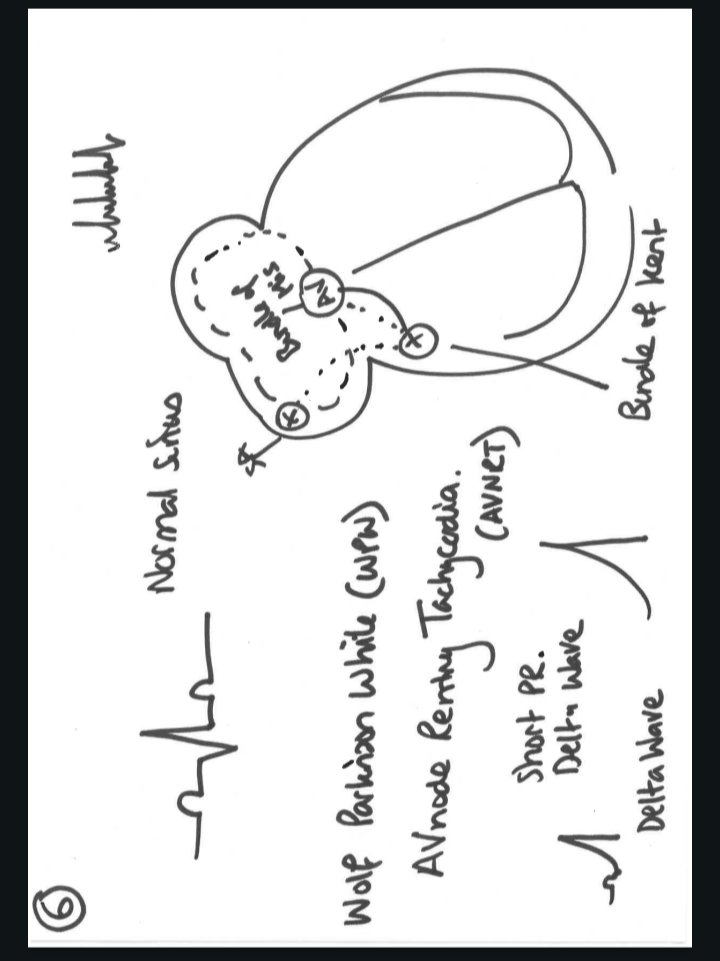 Another fun day of CPD delivery for a group of EMT and ECA colleagues, with some back to basics ECG teaching.....if only I could make my drawings less like a five year old 😎
<a href="/EEAST_UrgCare/">EEAST Primary & Urgent Care</a> <a href="/EastEnglandAmb/">EEAST Ambulance Service</a> #wigglylines #ECG
