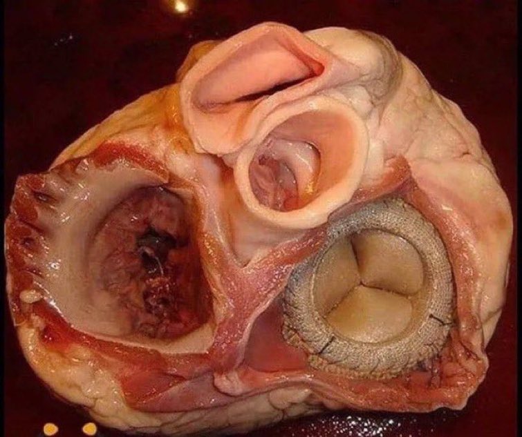 MujeebZubair's tweet photo. Magnificent view of heart valves 🫀(one of them is prosthetic ) https://t.co/AFJK05olAy